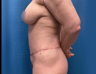 Lower Body Lift Before & After Patient #8051