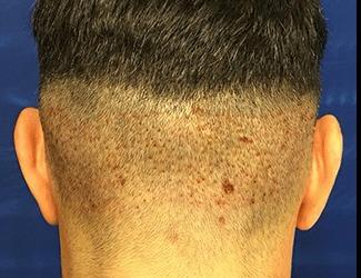 NeoGraft Before & After Patient #8825