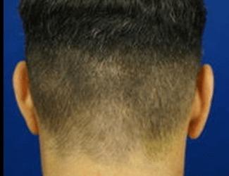 NeoGraft Before & After Patient #8825