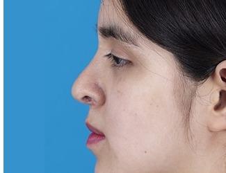 Rhinoplasty Before & After Patient #8807