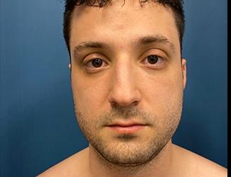 Submentoplasty Before & After Patient #8814