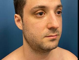 Submentoplasty Before & After Patient #8814