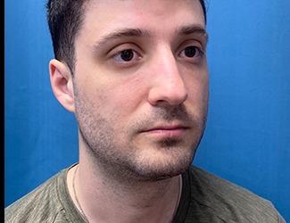 Submentoplasty Before & After Patient #8814