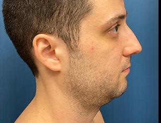 Submentoplasty Before & After Patient #8814