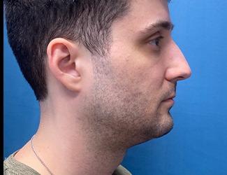 Submentoplasty Before & After Patient #8814