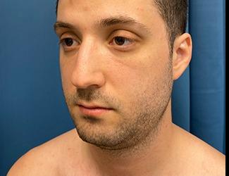 Submentoplasty Before & After Patient #8814