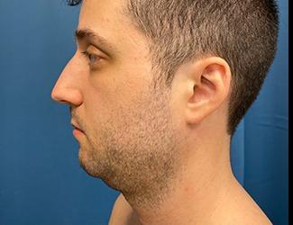 Submentoplasty Before & After Patient #8814