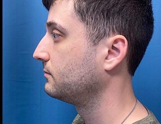 Submentoplasty Before & After Patient #8814