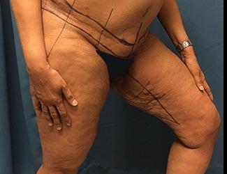 Thigh Lift Before & After Patient #8238