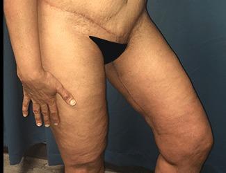 Thigh Lift Before & After Patient #8238