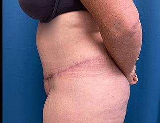 Tummy Tuck Before & After Patient #8216
