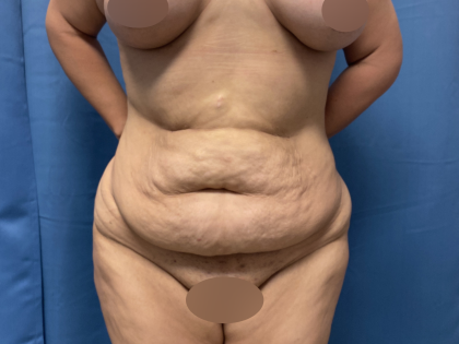 Tummy Tuck Before & After Patient #10937