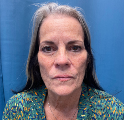 Facelift and Necklift Before & After Patient #11447