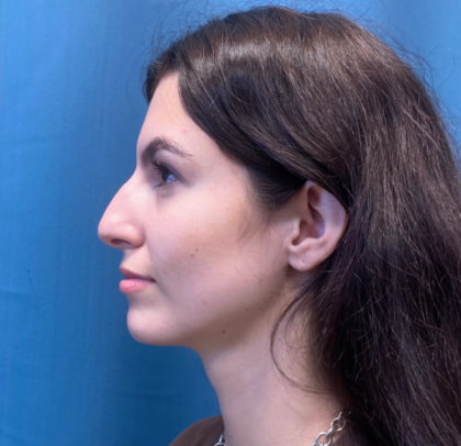 Rhinoplasty Before & After Patient #11450