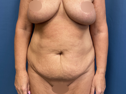 Tummy Tuck Before & After Patient #10926