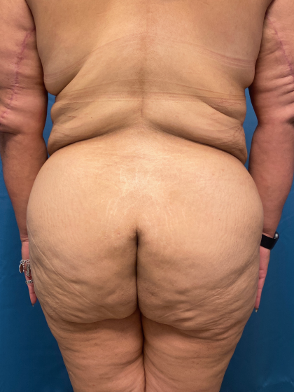 Lower Body Lift Before & After Patient #11438