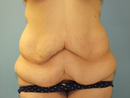 Tummy Tuck Before & After Patient #11013