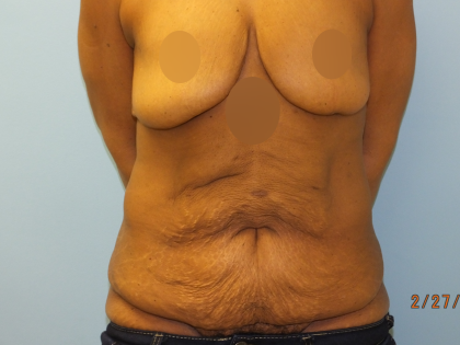 Tummy Tuck Before & After Patient #10950
