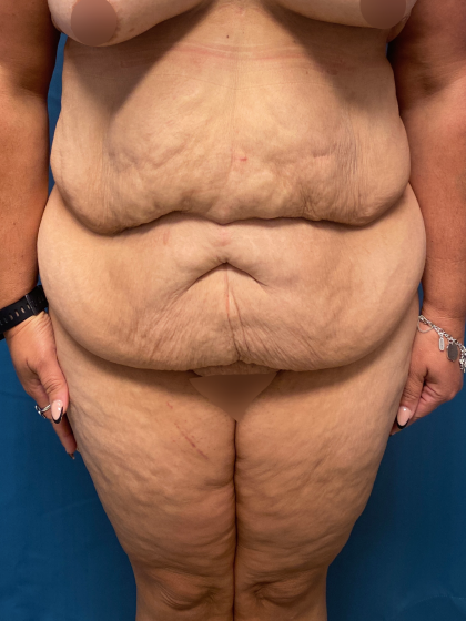 Lower Body Lift Before & After Patient #11438