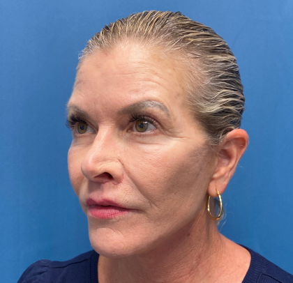 Lip Lift Before & After Patient #11448