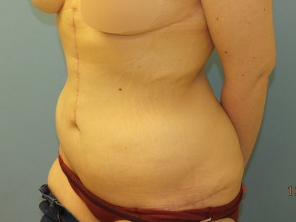 Tummy Tuck Before & After Patient #11013