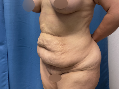 Tummy Tuck Before & After Patient #10937