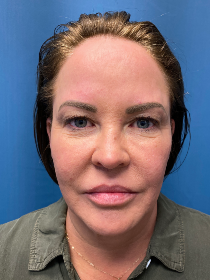 Blepharoplasty Before & After Patient #11835