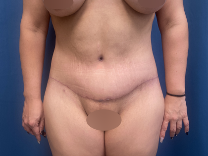 Tummy Tuck Before & After Patient #10937