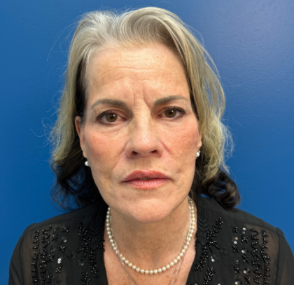 Facelift and Necklift Before & After Patient #11447