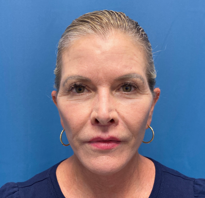 Lip Lift Before & After Patient #11448