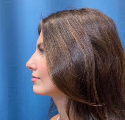 Rhinoplasty Before & After Patient #11450