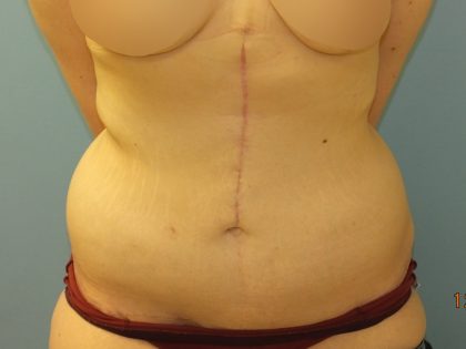 Tummy Tuck Before & After Patient #11013