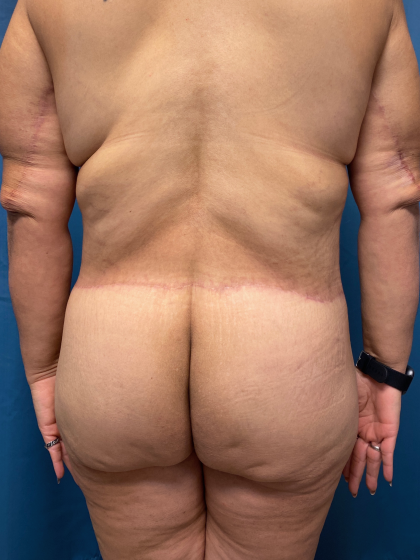 Lower Body Lift Before & After Patient #11438