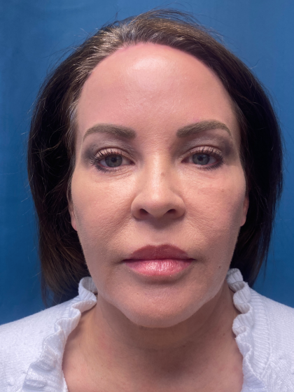 Blepharoplasty Before & After Patient #11835