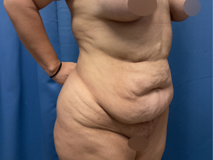 Tummy Tuck Before & After Patient #10937
