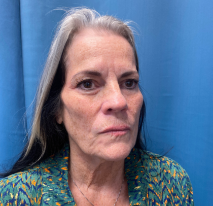 Facelift and Necklift Before & After Patient #11447