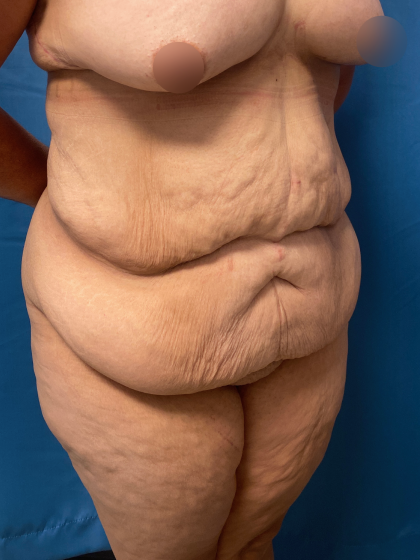 Lower Body Lift Before & After Patient #11438
