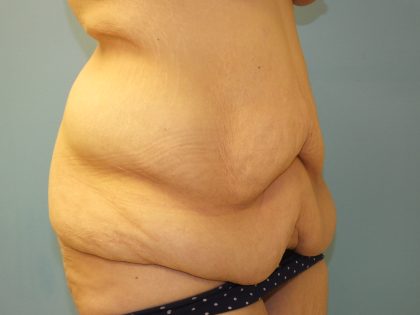 Tummy Tuck Before & After Patient #11013