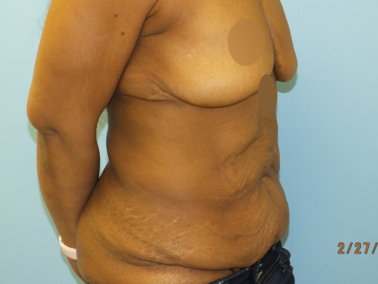 Tummy Tuck Before & After Patient #10950