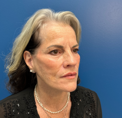 Facelift and Necklift Before & After Patient #11447