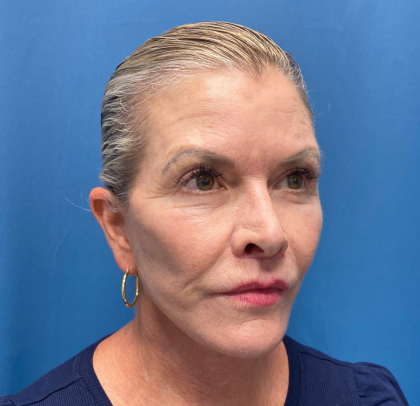 Lip Lift Before & After Patient #11448
