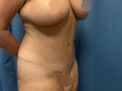 Tummy Tuck Before & After Patient #10926