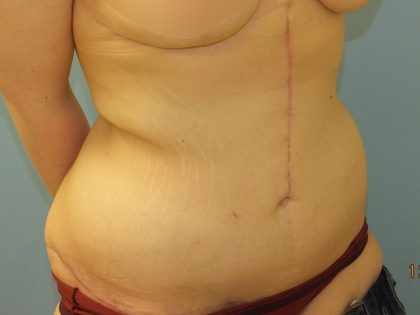 Tummy Tuck Before & After Patient #11013