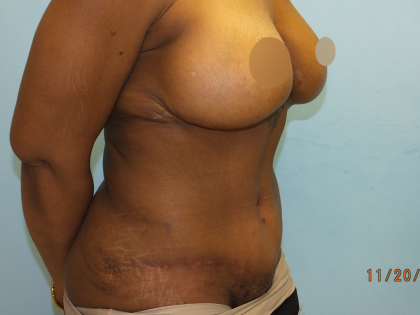 Tummy Tuck Before & After Patient #10950