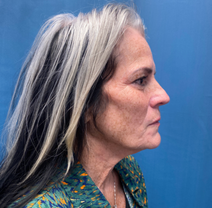 Facelift and Necklift Before & After Patient #11447