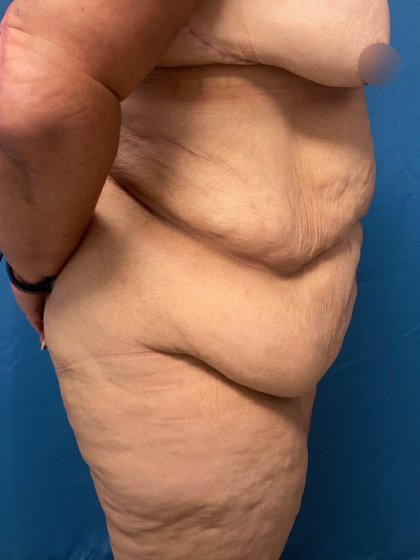 Lower Body Lift Before & After Patient #11438