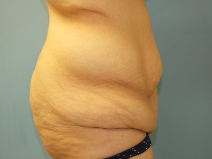 Tummy Tuck Before & After Patient #11013