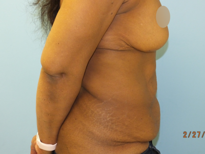 Tummy Tuck Before & After Patient #10950
