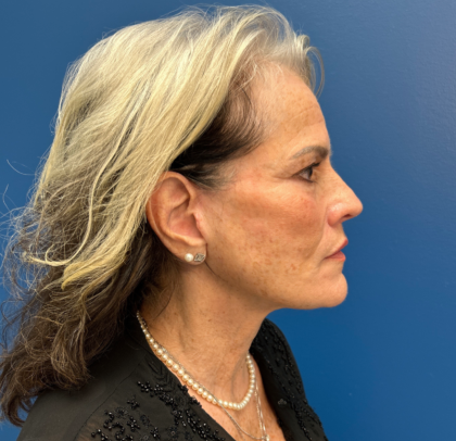 Facelift and Necklift Before & After Patient #11447