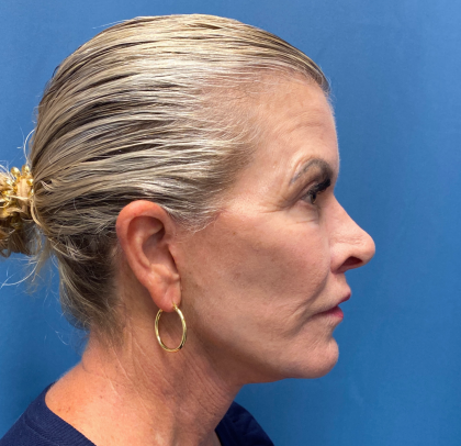 Lip Lift Before & After Patient #11448